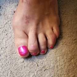 Chi Thomas, MD - This supposed hammer toe correction has left me almost walking on my toe nail! Terrible