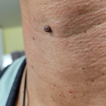 Mobile Skin Screening - Mole 1 before removal - Dermatologists Near Me Mobile Skin Screening - Mole 1 before removal - Dermatologists Near Me