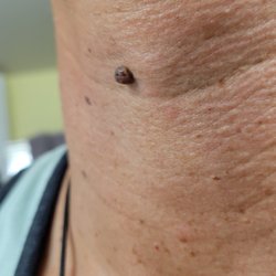 Mobile Skin Screening - Mole 1 before removal
