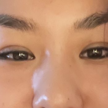 William Lao, MD - February 15 12 days after surgery. Back to contacts and light exercise with no issue - Cosmetic Surgeons Near Me - New York, New York William Lao, MD - February 15 12 days after surgery. Back to contacts and light exercise with no issue - Cosmetic Surgeons Near Me - New York, New York