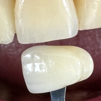 Vital Dental Lab - Shade - Laboratory Testing Near Me - Amherst, New York