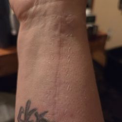 Franciscan Physician Network Orthopedic Specialists - But my arm looks like today