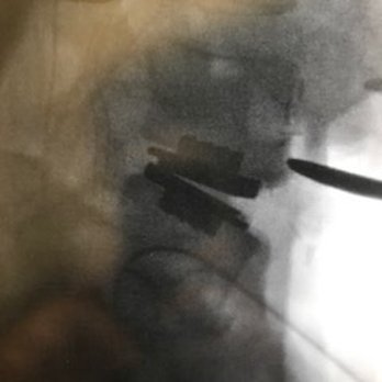 Edward Nomoto, MD - L4-L5 disc replacement - Spine Surgeons Near Me - Los Angeles, California