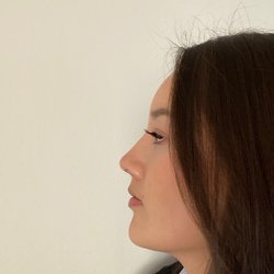 CARA Plastic Surgery & Laser Center - 6 month post op - I love my side profile
