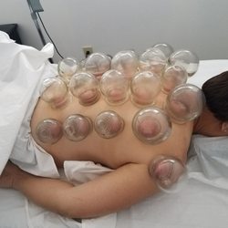 Hope Acupuncture & Herbs Clinic - Cupping treatments