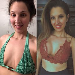 Before and After Breast Donut Lift Before and After Breast Donut Lift