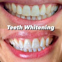 Lancaster Dental Group - We offer both in office and take home teeth whitening options. We strive to get that naturally whiter smile without the sensitivity.