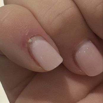 J'adore Nail Bar - My nail starting to drain on its own before I went to urgent care - Nail Salons Near Me - Carson, California J'adore Nail Bar - My nail starting to drain on its own before I went to urgent care - Nail Salons Near Me - Carson, California