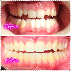Flintridge Dental Group - Invisalign before and after.