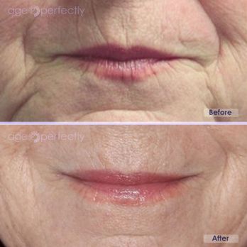 Age Perfectly - Lower face augmenation with Restylane 2 ml and Lips augmenation with Restylane Silk 1 ml. - Medical Spas Near Me - Wellesley, Massachusetts