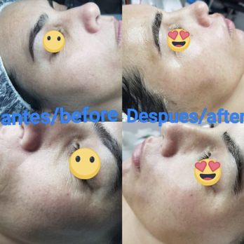 Facial Care With Yusi - Plasma microneedling after min done - Skin Care Near Me - Miami, Florida Facial Care With Yusi - Plasma microneedling after min done - Skin Care Near Me - Miami, Florida