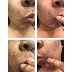Skin Essence By Pam - a few months later , it's getting worse . as you can see my skin is brightening , but look at my dark spots even darker!!