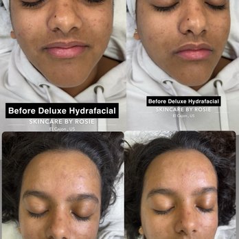 Skincare by Rosie - Deluxe Hydrafacial - Skin Care Near Me - El Cajon , California Skincare by Rosie - Deluxe Hydrafacial - Skin Care Near Me - El Cajon , California