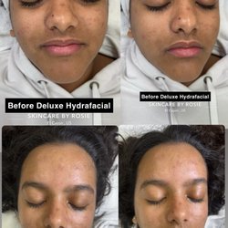 Skincare by Rosie - Deluxe Hydrafacial