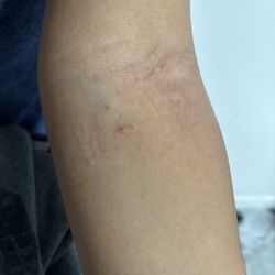 Lahey Medical Center - bottom poke is where he yanked it out without a warning...