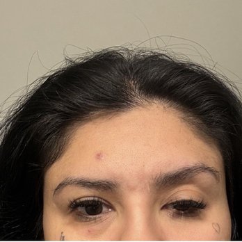Td Aesthetics - Ptosis before my eye fully closed and I was unable to drive or work - Medical Spas Near Me - Los Angeles, California Td Aesthetics - Ptosis before my eye fully closed and I was unable to drive or work - Medical Spas Near Me - Los Angeles, California