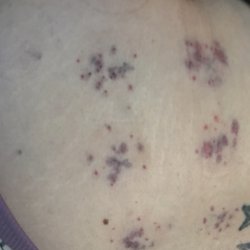Advanced Acupuncture - Very painful, burning bruises, after "wet cupping" on my lower back - that I paid an additional $60 for.