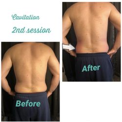 Mi Pollera Spa - Cavitation