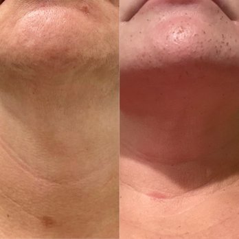 Oc Brow Game - Chin and neck - Permanent Makeup Near Me - Mission Viejo, California