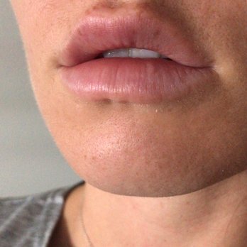 Daniel Moghadam , MD - Modern Aesthetica - 1 syringe lip fillers - Medical Spas Near Me - Beverly Hills, California