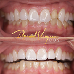 Daniel Vasquez, DDS - Single front veneer in Oceanside, CA. Restore one tooth with natural, seamless results using digital dentistry.