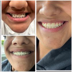 San Leandro Braces