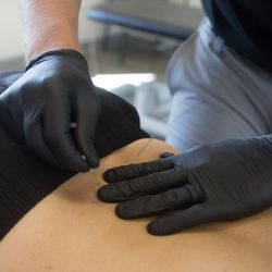 Aspire Physical Therapy - Dry Needling