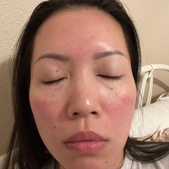 The One Acupuncture Aesthetics & Tea Bar - 6 hours post chemical peel - Acupuncture Near Me - Austin, Texas