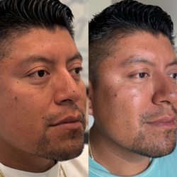 Muna's Signature mid-face volume restoration