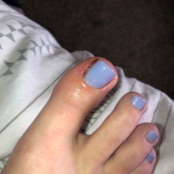 Moon's Nails and Spa - Bloody toe from the rough pedicure. The nail isn't even fully painted. - Nail Salons Near Me - Davis, California Moon's Nails and Spa - Bloody toe from the rough pedicure. The nail isn't even fully painted. - Nail Salons Near Me - Davis, California