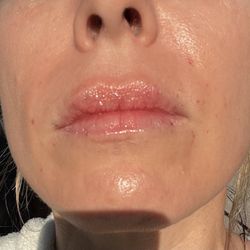 Jule’s Fibroblast & Body Contour