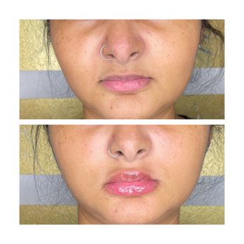 Le Rose Beauty Ave - Lip Filler - Waxing Near Me Le Rose Beauty Ave - Lip Filler - Waxing Near Me