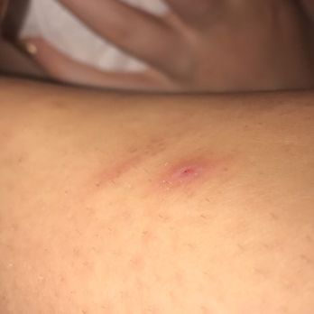 IHOP - Bruise from Mop - Breakfast & Brunch Near Me - Cedar Park, Texas IHOP - Bruise from Mop - Breakfast & Brunch Near Me - Cedar Park, Texas