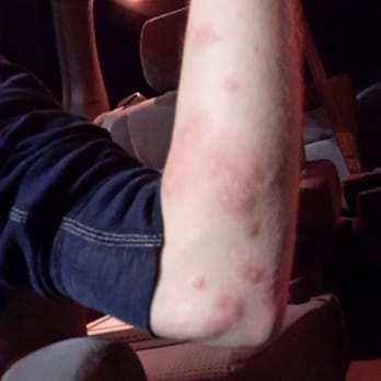 Candlewood Suites Lafayette - More bed bug bites while at the hotel. - Hotels Near Me - Lafayette, Indiana Candlewood Suites Lafayette - More bed bug bites while at the hotel. - Hotels Near Me - Lafayette, Indiana