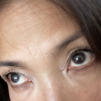 BeautyFix - Freckles, freckles, everywhere; use a dab of cream. - Medical Spas Near Me - West Hartford, Connecticut BeautyFix - Freckles, freckles, everywhere; use a dab of cream. - Medical Spas Near Me - West Hartford, Connecticut