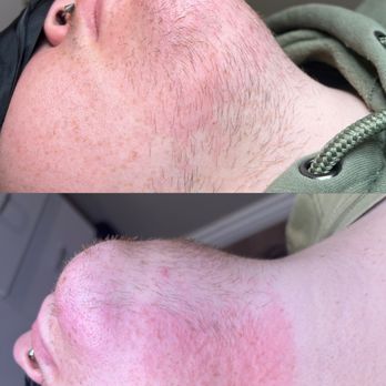 Power Pulse Electrology - The patient is freshly starting electrolysis treatments. The previous removal method was shaving. - Hair Removal Near Me - Los Angeles, California Power Pulse Electrology - The patient is freshly starting electrolysis treatments. The previous removal method was shaving. - Hair Removal Near Me - Los Angeles, California