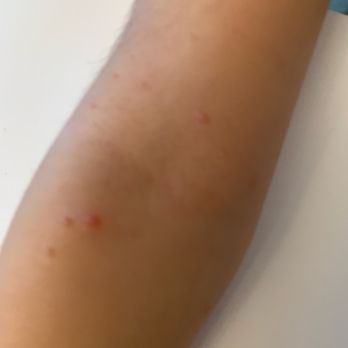 Rhodes Lisa MD - Before photo of tiny bumps. - Dermatologists Near Me - Austin, Texas Rhodes Lisa MD - Before photo of tiny bumps. - Dermatologists Near Me - Austin, Texas