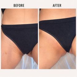 The Sugaring Suite - Before and after of bikini line