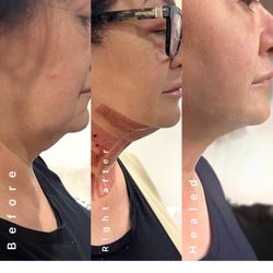 Elavine Microblading - #Plasma #fibroblast skin tightening before after two weeks post