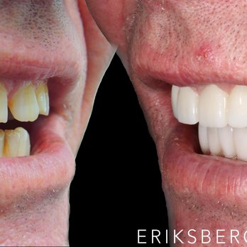 Eriksbergs Tandvård - Tandläkare hisingen Göteborg porslinskronor - Cosmetic Dentists Near Me - Göteborg, O Eriksbergs Tandvård - Tandläkare hisingen Göteborg porslinskronor - Cosmetic Dentists Near Me - Göteborg, O