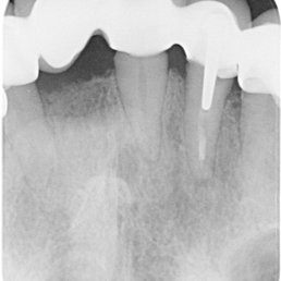 Dr. Thomas Meyer - Normal dürfte zwischen der Brücke und den Zahnfleisch keine schwarze große Frei Fläche sein und die neue Brücke hätte bündig zum Zahnfleisch - Dentists Near Me - Willich, NW