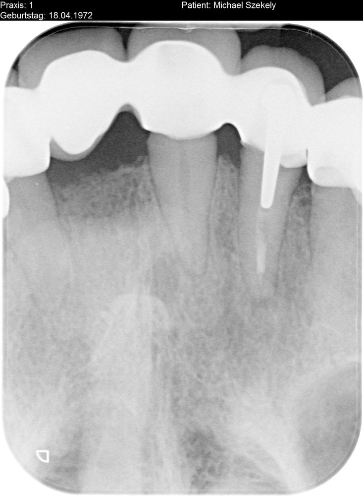 Dr. Thomas Meyer - Normal dürfte zwischen der Brücke und den Zahnfleisch keine schwarze große Frei Fläche sein und die neue Brücke hätte bündig zum Zahnfleisch - Dentists Near Me - Willich, NW Dr. Thomas Meyer - Normal dürfte zwischen der Brücke und den Zahnfleisch keine schwarze große Frei Fläche sein und die neue Brücke hätte bündig zum Zahnfleisch - Dentists Near Me - Willich, NW