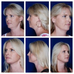 Blackhawk Plastic Surgery & MedSpa - Neck Lift Patient Before and Afters