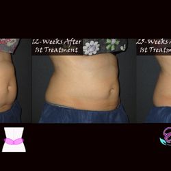 Elite Salon And Medspa - CoolSculpting