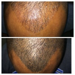 Uptown Esthetics - Scalp pigmentation to give the appearance of a fuller head of hair.