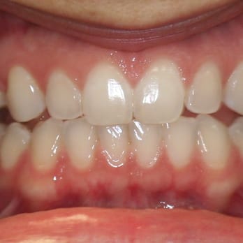Gateway Dental Care - before lumineers - General Dentistry Near Me - Pleasanton, California Gateway Dental Care - before lumineers - General Dentistry Near Me - Pleasanton, California