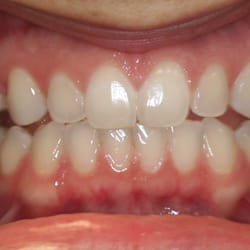 Gateway Dental Care - Before lumineers
