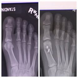 Northwest Orthopedic Surgery - Before and after...no more pain!