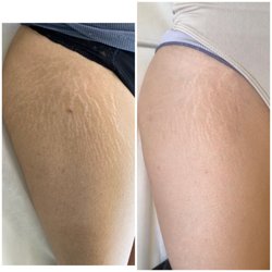 Boleyn studio - Stretch marks