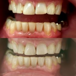 Body By Nickie - Teeth whitening